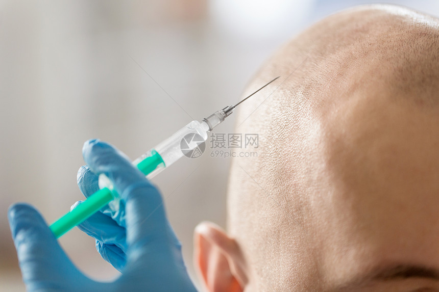 医学,中间疗法整容手术的密切美容师医生的手与注射器,头发生长血清注射秃头男皮肤用注射器秃头男头把手收来图片