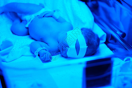 血症两天大的新生婴儿蓝色紫外线下拍照背景