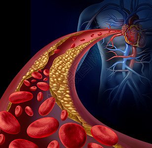 一血堵塞动脉动脉粥样硬化疾病的医学与个三维人动脉与血细胞,被斑块建立胆固醇动脉硬化血管疾病的象征而阻断背景