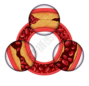 冠状动脉疾病的三维血管解剖图背景