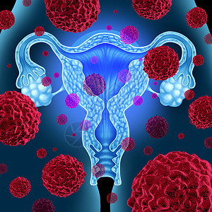 细胞癌变子宫子宫癌医学癌细胞女体内扩散,攻击生殖系统解剖,包括卵巢输卵管,宫颈癌生长治疗风险的保健标志背景