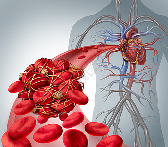 血块风险血块血栓医学插图符号,人类血细胞聚集,由粘稠的血小板纤维蛋白造成动脉静脉阻塞,导致心脏图片