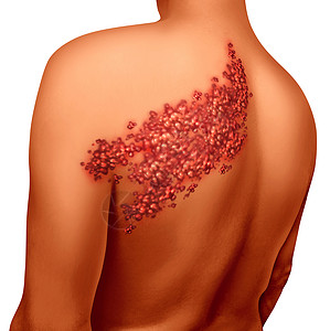 背部带状疱疹疾病感染的荨麻疹疮高清图片