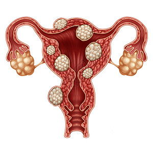 子宫肌瘤医学人类女生殖子宫疾病的象征高清图片