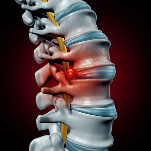 人椎间盘突出的脊柱疼痛诊断人类脊柱系统的符号医疗健康问题解剖符号,以骨骼骨结构椎间盘特写为三维插图疝出高清图片素材
