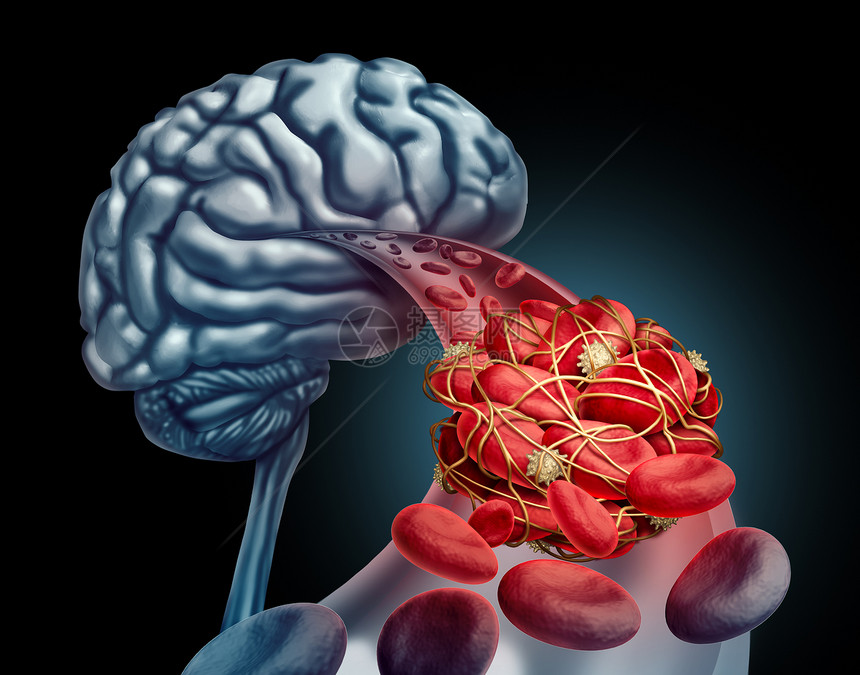 血凝块脑医学三维图示血细胞被动脉堵塞血栓堵塞,导致血液流动堵塞神经学解剖黑色背景图片