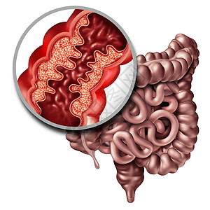 克罗娜疾病克罗恩病医学种接近人体肠道的炎症症状,引阻塞,三维插图图片