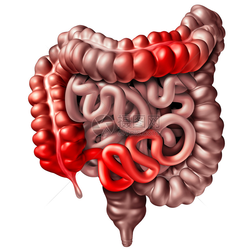 克罗娜疾病克罗恩病医学人类肠道炎症症状引梗阻的三维图示图片