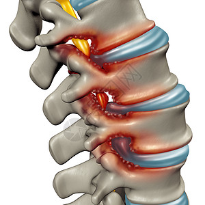 椎管狭窄种退行疾病,人体椎骨中引压缩脊柱神经的医学三维插图背景