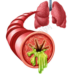 肺元素支气管炎解剖支气管衬里的种炎症,厚厚的粘液分泌为胸冷三维插图元素背景
