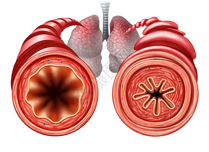 哮喘图种健康健康的支气管管,呼吸困难,呼吸肌收紧引呼吸问题,3D插图元素背景图片