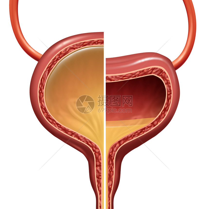 膀胱种正常过度活跃的泌尿器官比较,代表了自主的尿液丢失,种健康健康的情况与三维插图元素图片