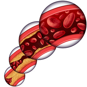 冠状动脉胆固醇治疗医学种静脉,堵塞的动脉动脉粥样硬化中逐渐清除斑块,并附减少胆固醇积累的三维人体解剖图背景图片