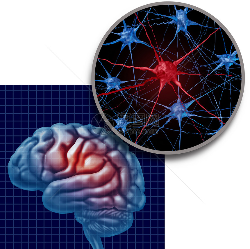 帕金森脑解剖帕金森病患者疾病帕金森病症状个人的头部,神经元,代表健康损失老退行神经病学疾病的三维插图风格图片