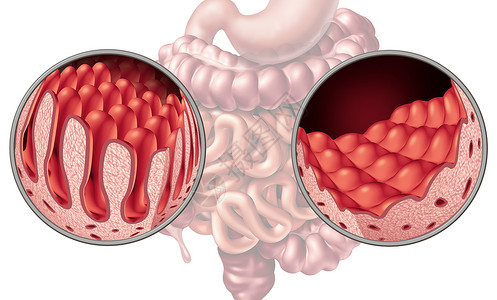 腹腔腹腔肠道疾病解剖医学与正常绒毛受损的小肠衬里自身免疫疾病的消化系统,结肠胃三维插图背景图片