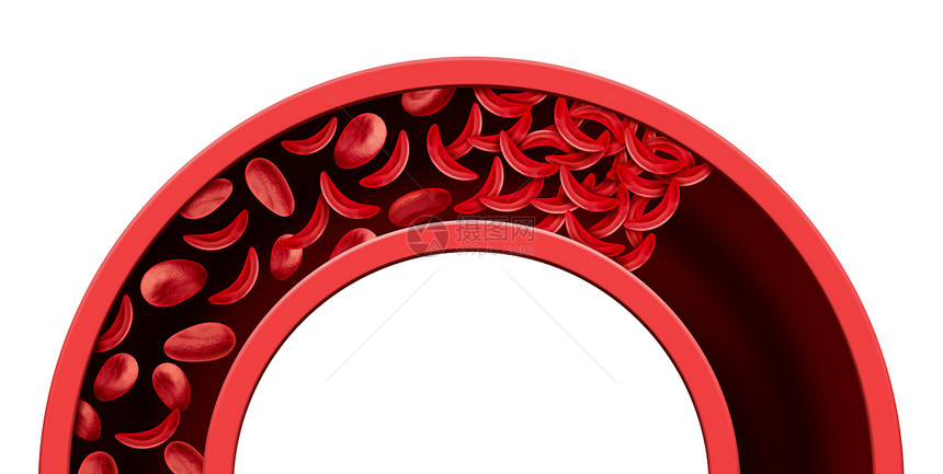 镰状细胞血管阻塞贫血种正常异常血红蛋白的疾病,阻塞的动脉静脉解剖医学插图三维渲染图片