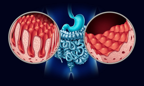 腹腔腹腔疾病种肠道解剖医学,正常绒毛受损的小肠衬里消化系统的自身免疫疾病,结肠胃三维图示背景图片