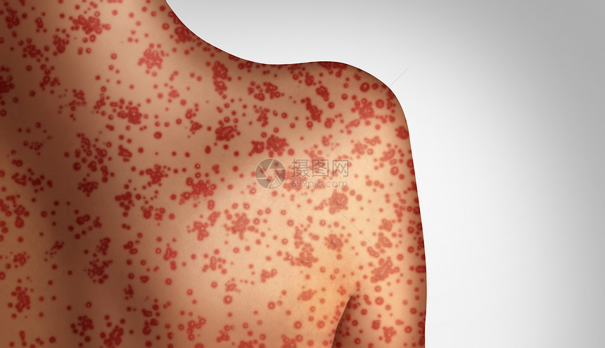 麻疹种致命的爆发免疫,疾病病疾病种传染水痘皮疹的三维插图风格图片