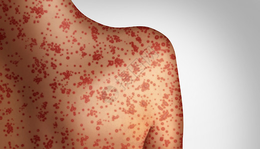 麻疹种致命的爆发免疫,疾病病疾病种传染水痘皮疹的三维插图风格图片