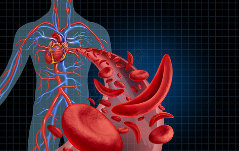 心血管堵塞镰状细胞心血管血液循环贫血种疾病与正常异常血红蛋白人动脉解剖医学插图与三维插图元素背景