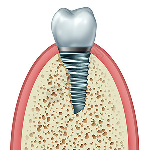 牙种植体牙齿假体的,颌骨牙龈内,用正畸冠切除金属螺钉白色背景上分离,正畸牙科手术的象,三维插图背景图片