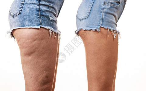 女腿部大腿与非纤维素的比较皮肤问题,身体护理,超重节食的腿与含纤维素的比较背景图片