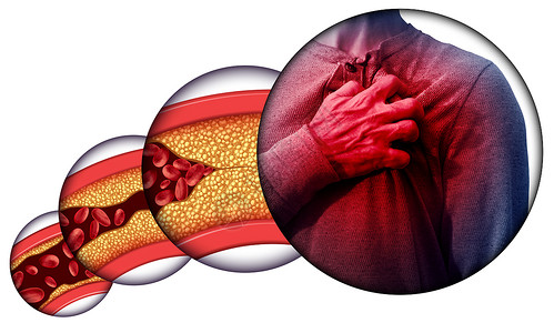 冠状动脉粥样硬化人类心脏病胸痛由堵塞的动脉动脉损害胆固醇导致心脏骤停与三维插图元素背景