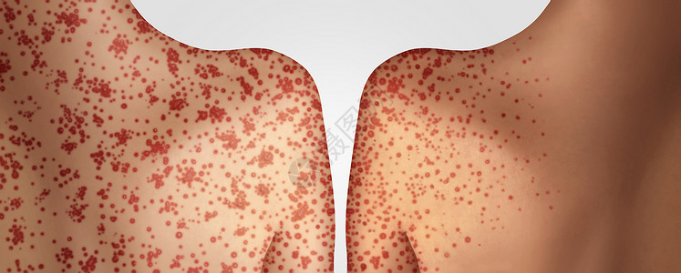 传播麻疹种致命的爆发,免疫疾病病疾病种传染传播水痘皮疹的三维插图风格图片