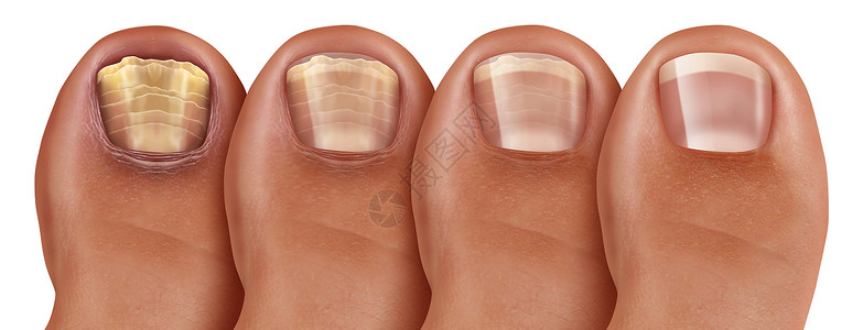 真菌指甲感染恢复图甲真菌病癣治疗感染的脚趾甲脚趾甲与受损的健康健康的人体解剖三维插图风格背景图片