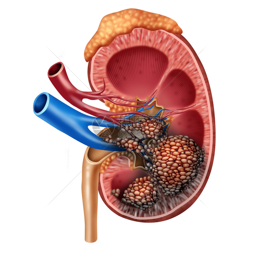 人肾癌解剖医学人体肿瘤细胞攻击泌尿系统肾解剖肿瘤生长治疗风险的标志与三维插图元素图片