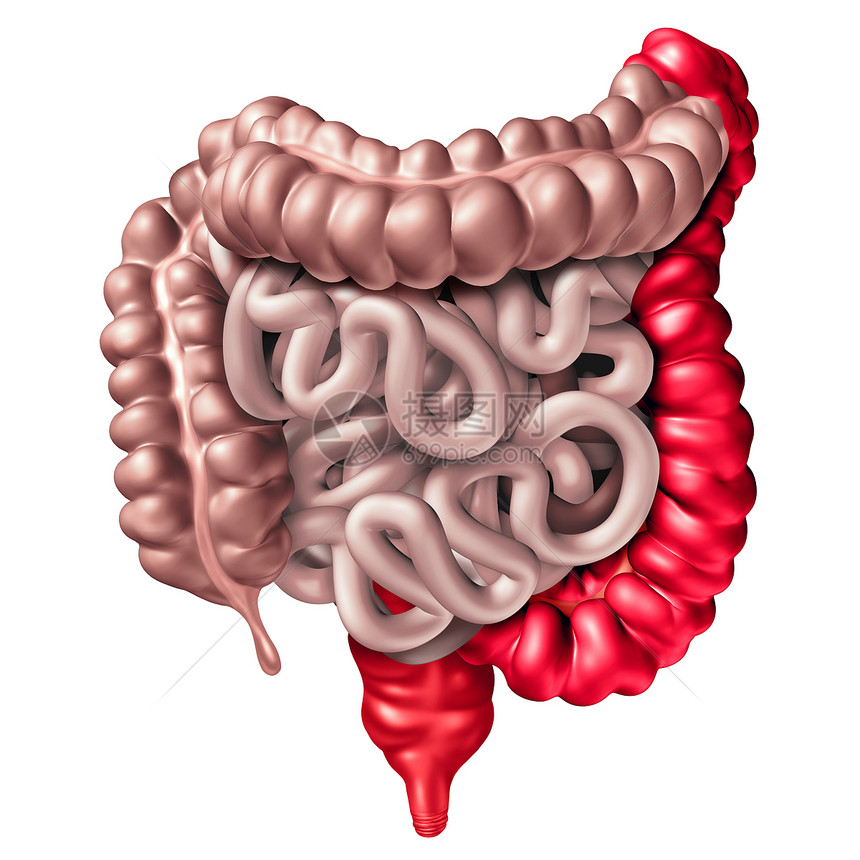 溃疡结肠炎种炎症肠病,以人直肠结肠为消化系统器官消化体部分,以白色发炎的大肠为3D图示图片