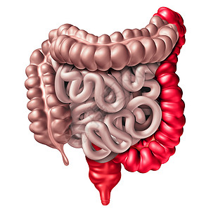 胃食管溃疡结肠炎种炎症肠病,以人直肠结肠为消化系统器官消化体部分,以白色发炎的大肠为3D图示背景