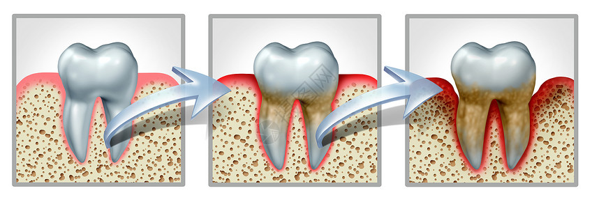 牙齿牙龈疾病医学牙科图表的,健康的牙齿,牙龈炎牙周炎,导致炎症骨丢失,因为良的口腔卫生个三维说明背景图片