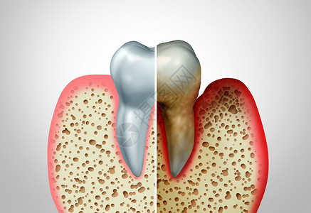 牙齿建模图牙龈疾病与健康牙齿健康牙齿的比较,牙周炎良的口腔卫生健康问题细菌感染图的,以炎症为三维图背景