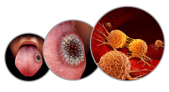 舌癌医学鳞状细胞癌口腔恶肿瘤疾病与三维插图元素高清图片
