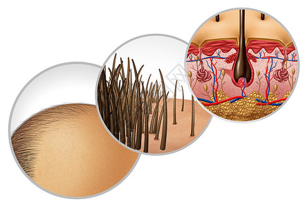 头发结构脱发图秃头秃头脱发种后退的发际线化妆品毛囊变薄脱发皮肤解剖与三维插图元素的特写背景