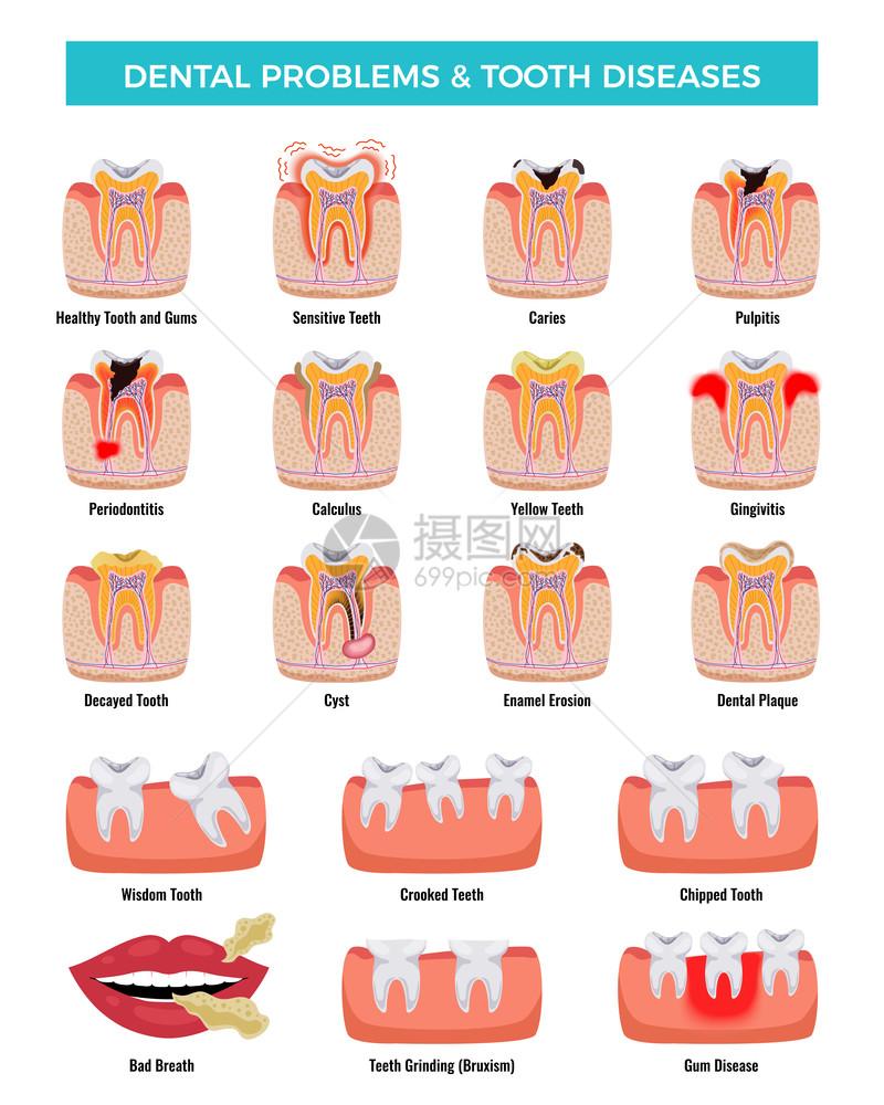 口腔问题教育信息摄影集龋炎牙菌斑,口臭,搪瓷侵蚀矢量插图图片
