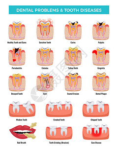 口腔问题教育信息摄影集龋炎牙菌斑,口臭,搪瓷侵蚀矢量插图插画