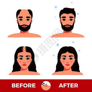 胡子头发男女头发移植前后的白色背景平矢量插图插画