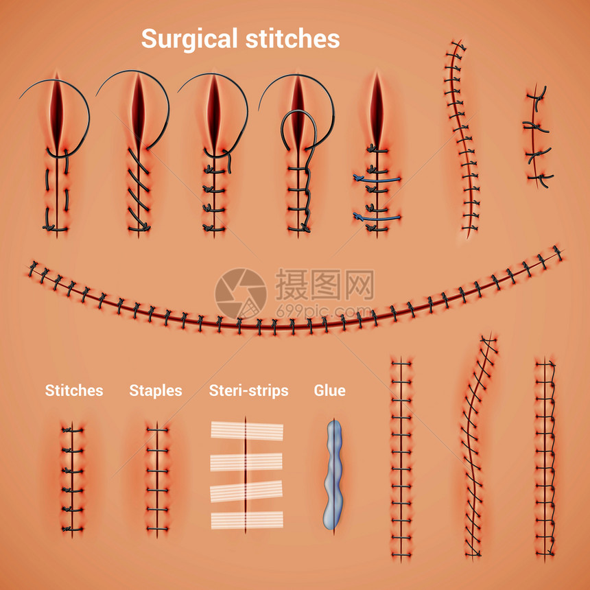 手术缝合缝合线真实的缝合方法形状与订书机胶水文本标题矢量插图图片