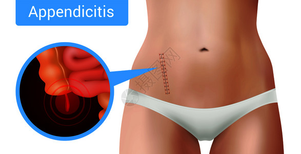 手术缝合缝合线真实阑尾炎的成,以手术干预标记的现实女身体矢量插图图片