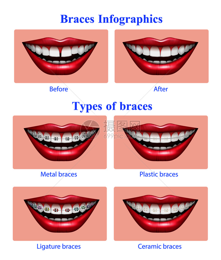 张开的嘴与红色光泽的嘴唇金属塑料陶瓷牙套类型真实的信息矢量插图图片