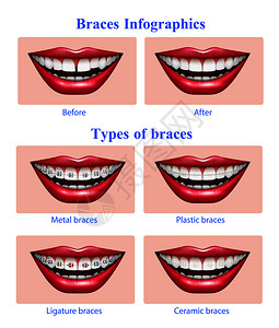 女性牙齿张开的嘴与红色光泽的嘴唇金属塑料陶瓷牙套类型真实的信息矢量插图插画