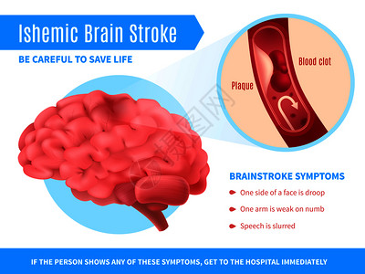 分子结构与大脑缺血脑卒中现实海报与症状清单,并呼吁小心拯救生命矢量插图缺血脑卒中海报插画