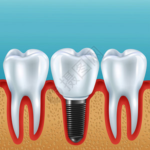 雕版印刷术牙科假肢现实向量插图与健康牙齿义齿冠植入种植体种植牙的现实插图插画
