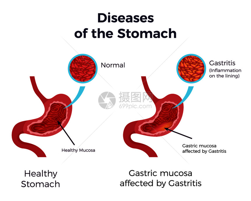 胃炎胃套图片
