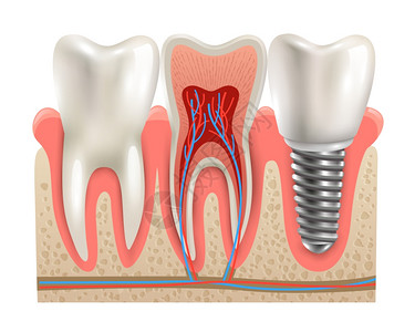醋溜段牙种植体解剖特写模型牙种植体真实牙齿解剖特写切段模型侧视真实向量插图插画