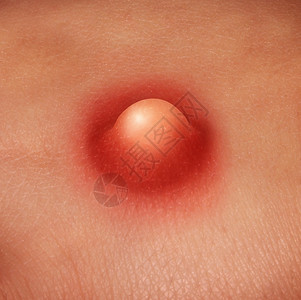 丘疹人体皮肤上被细菌感染的颗粒设计图片
