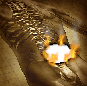 被枷锁锁住烟人类背痛和的医学概念是用一个老旧文件来证明上身躯骨骼脊椎和柱被火焰烧焦烟雾作为脊椎问题的保健标志背景