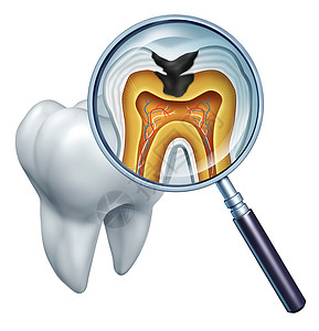 放大镜牙齿由于细菌和口腔保健中的酸细菌腐烂的放大镜和牙解剖的交叉部分以及口腔保健中的酸腐烂和缺乏刷牙导致的疾病显示放大镜和牙解剖的腐烂设计图片